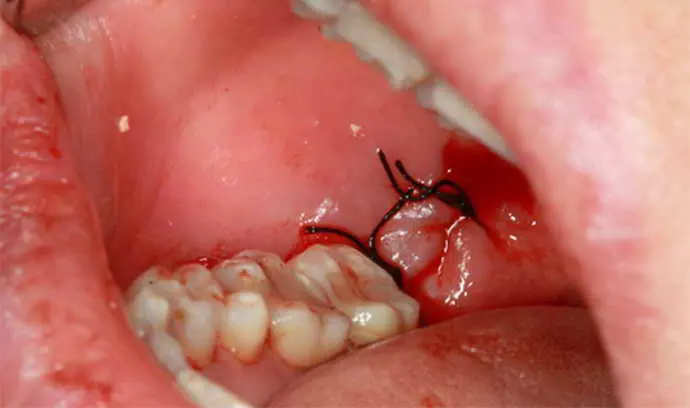 Чи боляче знімати шви після видалення зуба 1