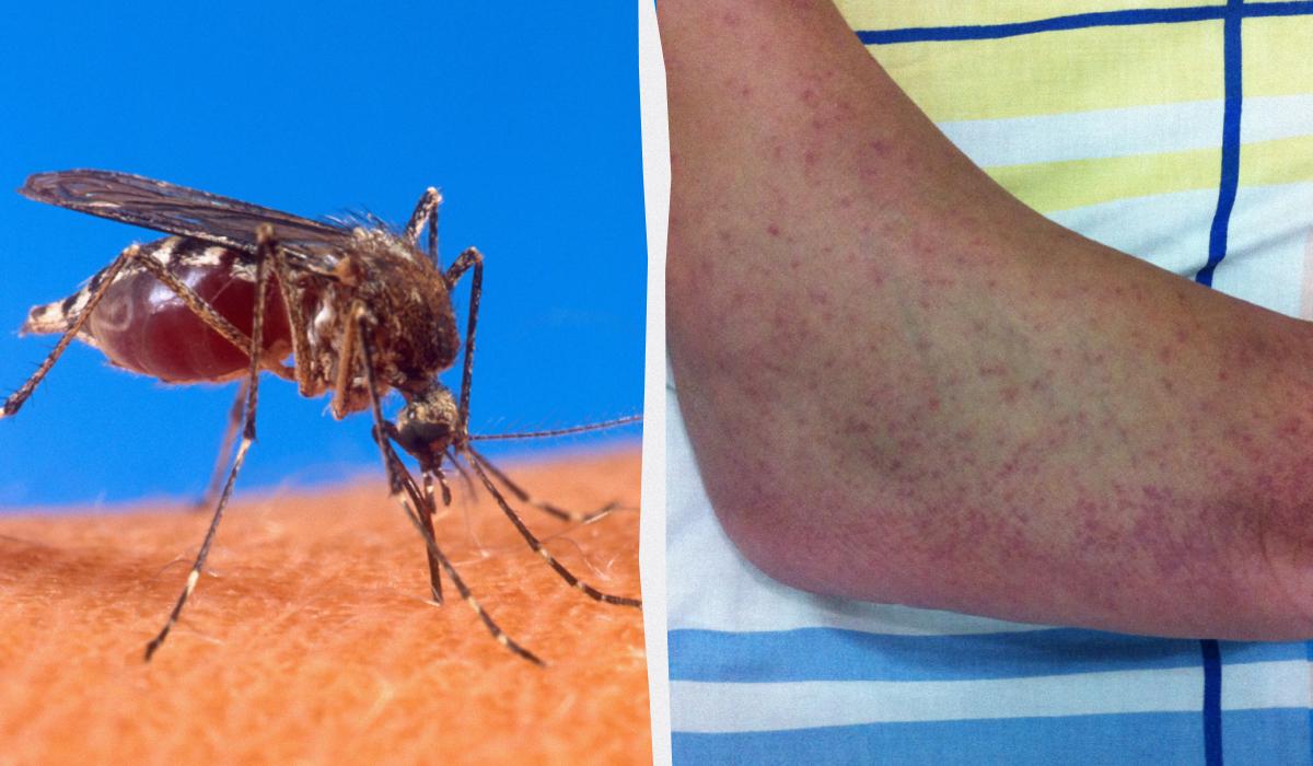 Небезпечна тропічна інфекція загрожує майже всій Європі, - The Guardian 1 Небезпечна тропічна інфекція загрожує майже всій Європі, - The Guardian