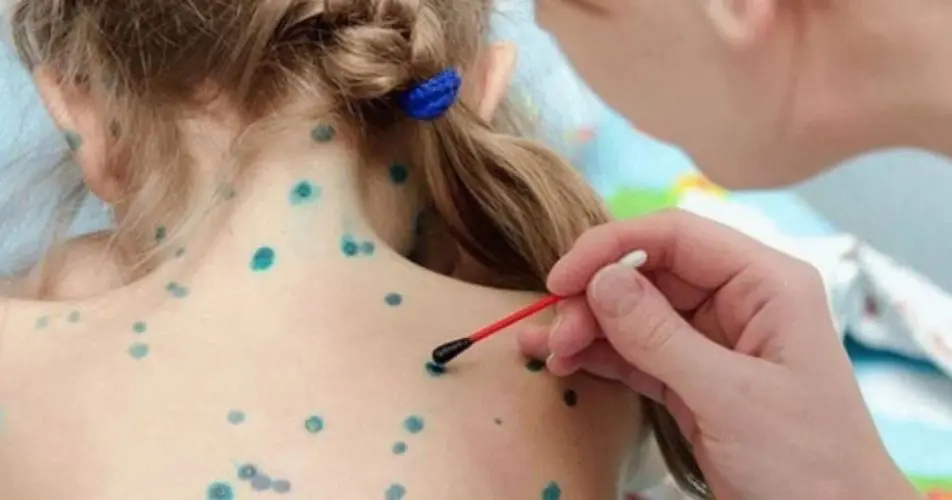 Вітрянка: чим мазати висипку без ризику шрамів 1