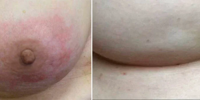 Як виглядає рак грудей: симптоми на ранніх стадіях 1