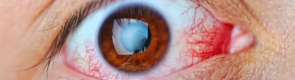 Чому печуть очі: причини від сухості до алергії 1